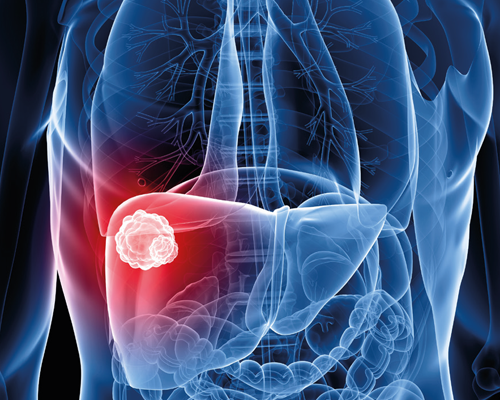 Nódulos no fígado. Devo me preocupar?