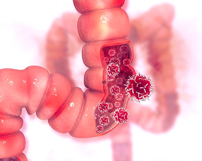 Câncer de intestino, exames que ajudam na prevenção