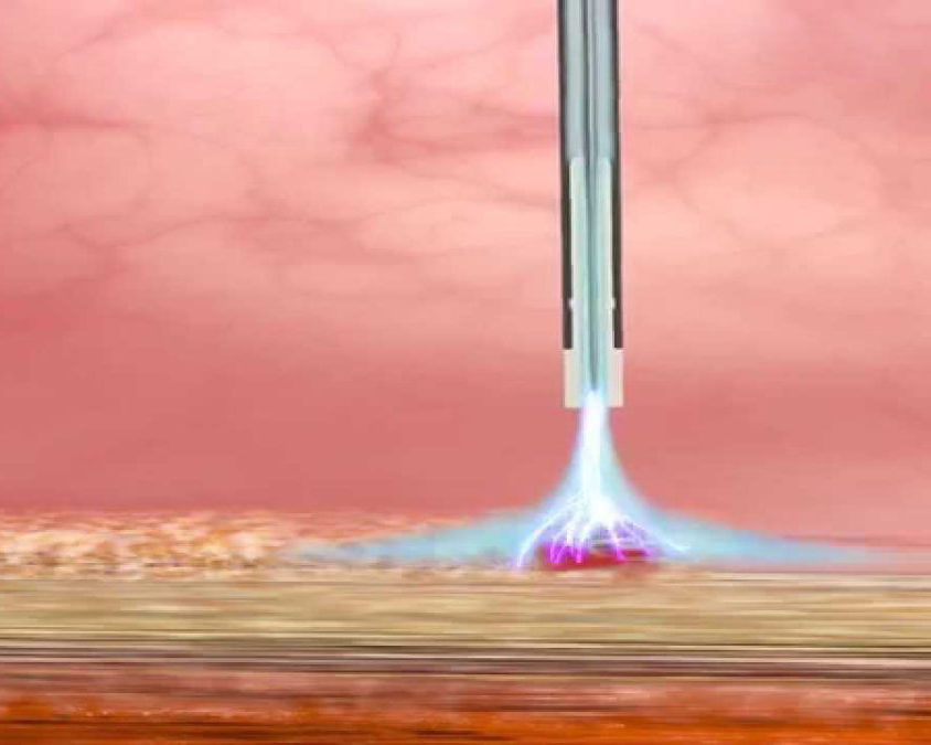 Reganho de peso após cirurgia bariátrica. Plasma de argônio por endoscopia!