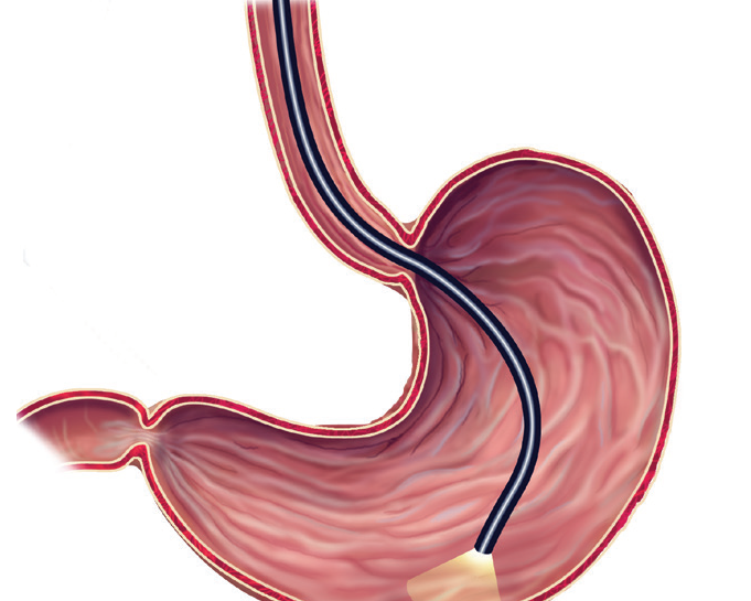 Endoscopia: o que você precisa saber?